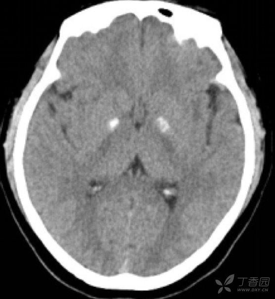 双侧苍白球对称性钙化,边界清晰