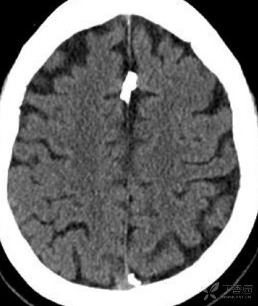 3. 硬脑膜 大脑镰,天幕游离缘钙斑.60 岁以后,大脑廉易钙化. 4.