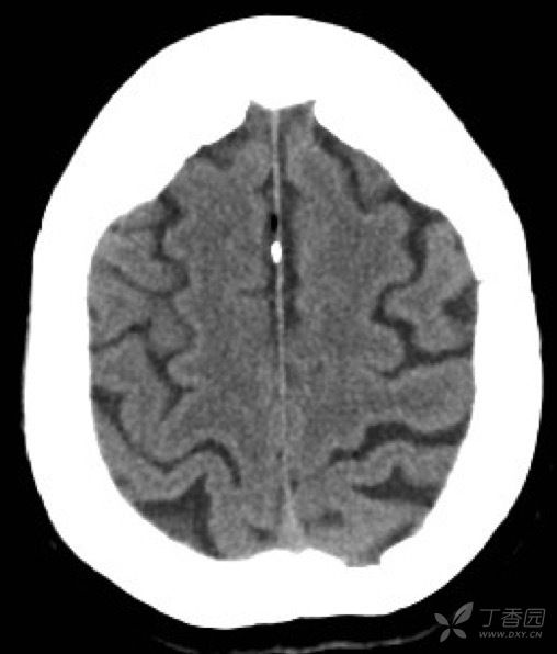 大脑镰小结节钙化,注意前部可见小脂肪瘤