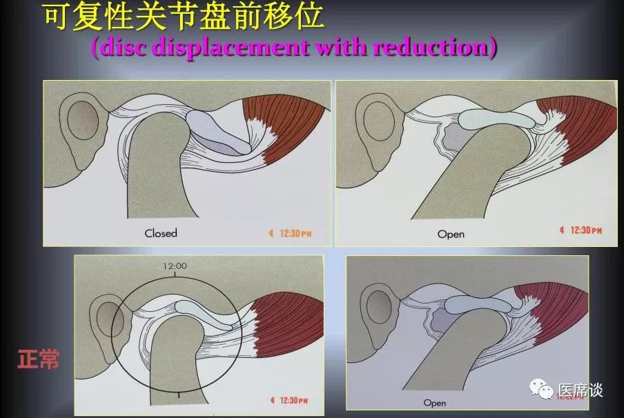 可复性关节盘前移位又分为伴有绞索的和不伴有绞索的.