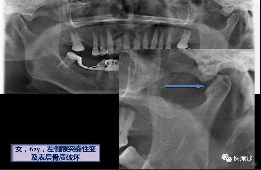 颞颌关节紊乱病—解放军总医院口腔外科专业讨论群微信公开课之十一