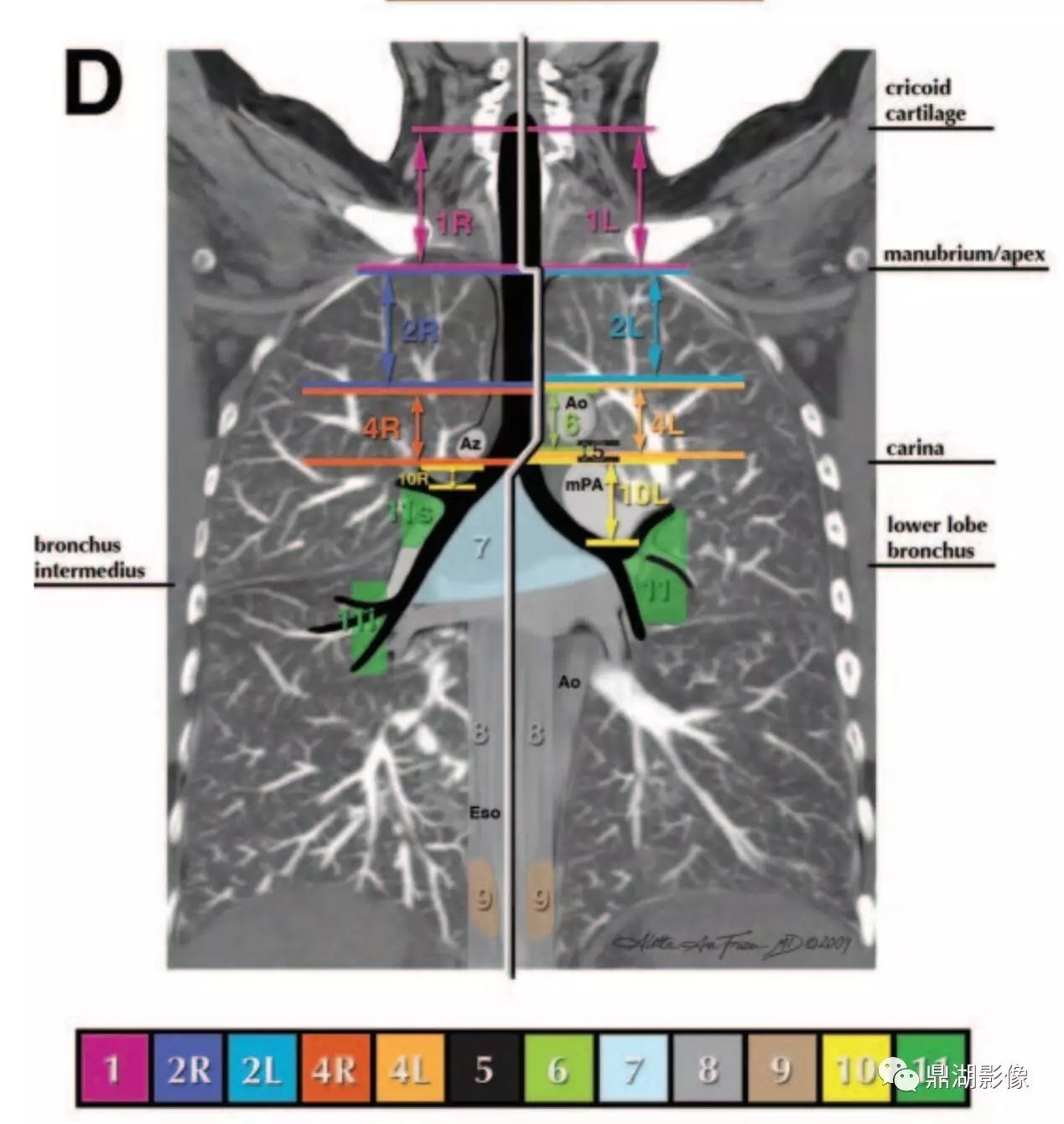 一文搞懂 | 纵膈及肺部淋巴结分区解读(肺癌)