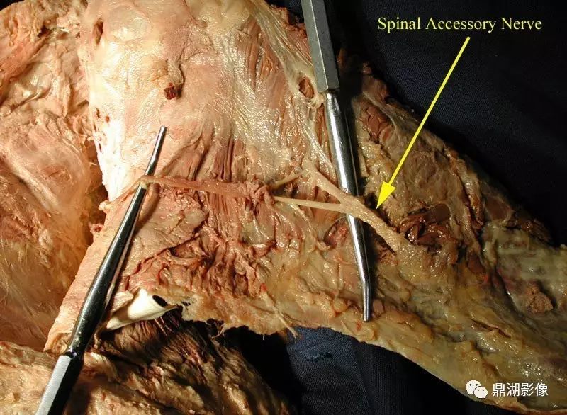 ▍ 胸背神经(thoracodorsal nerve)