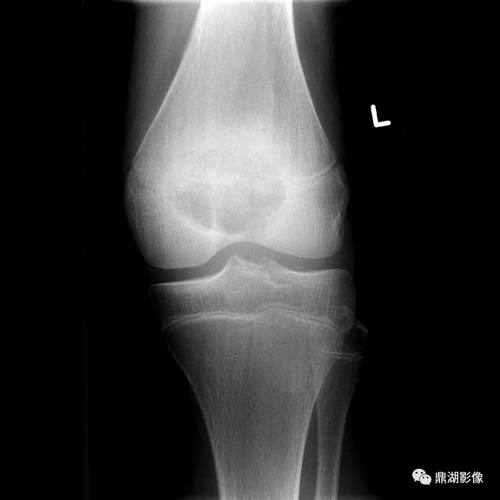 > 六种长管状骨干骺端常见良性疾病