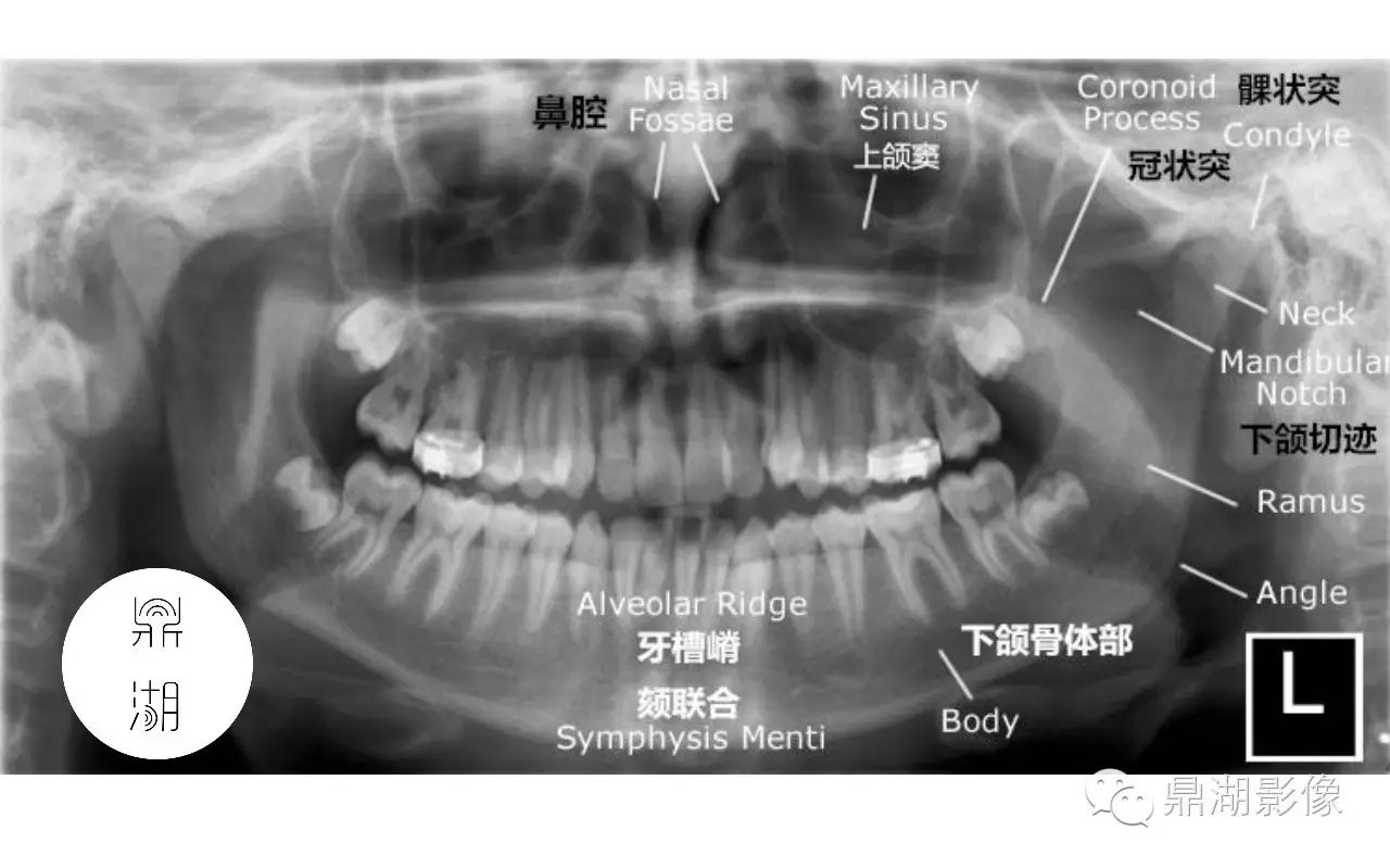 x线解剖 下颌骨解剖