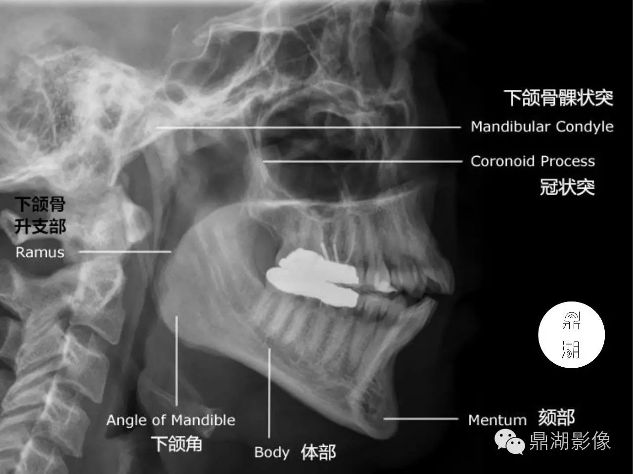 x线解剖 下颌骨解剖