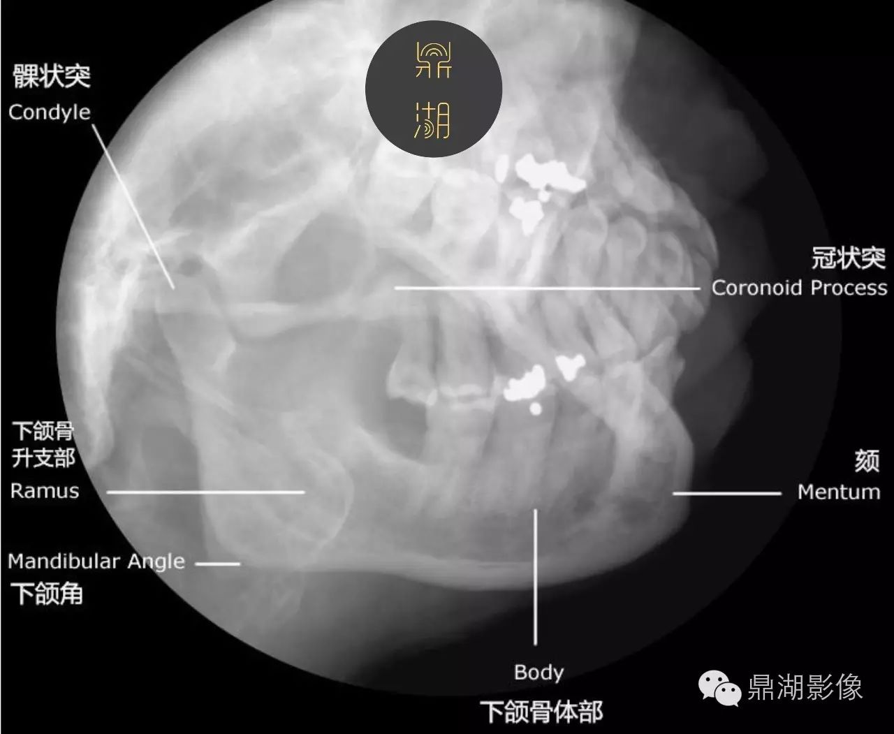 x线解剖下颌骨解剖