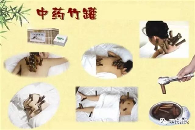 【中医养生】中药竹罐，以自然之道、养自然之身