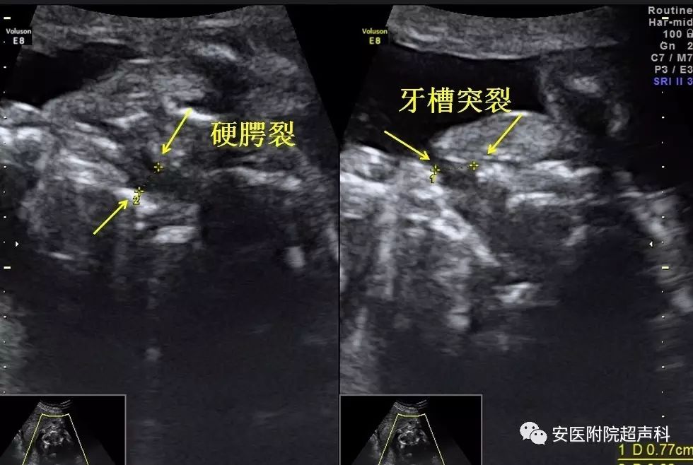 单侧完全性唇腭裂之横切面显示硬腭裂