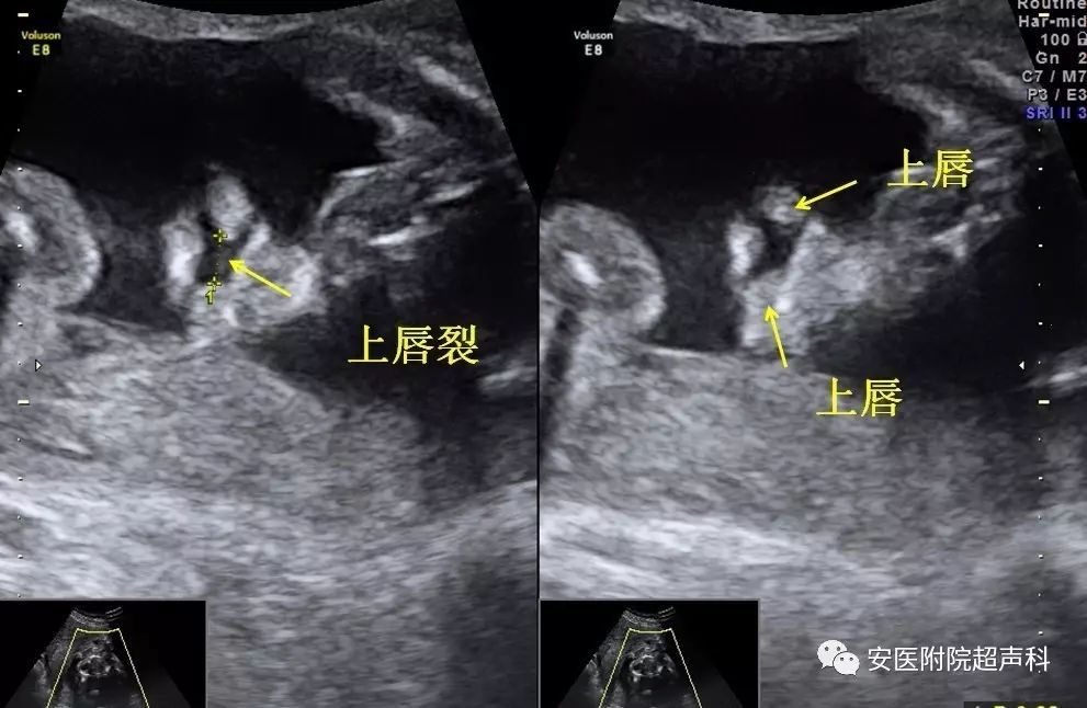 单侧完全性唇腭裂之鼻唇冠状切面显示唇裂