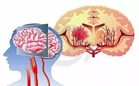 医生诊断是因为血管硬化引起脑部血管破裂,病发后死亡率极高.