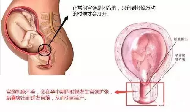 宫颈环扎失败医生有责任吗_15周宫颈环扎20周失败_宫颈环扎失败的原因