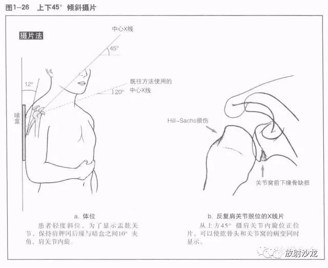 (2)肩胛骨的x线解剖在后前位x线片上,肩胛骨呈倒置的三角形,覆盖于第