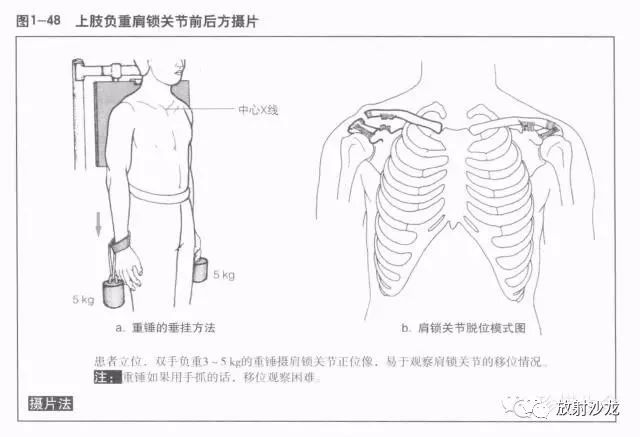 (1)锁骨的x线解剖在后前位x线片上,长管状的锁骨,重叠在肺尖部,把胸骨