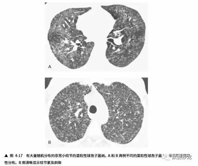 多发结节的hrct鉴别诊断攻略一文读懂