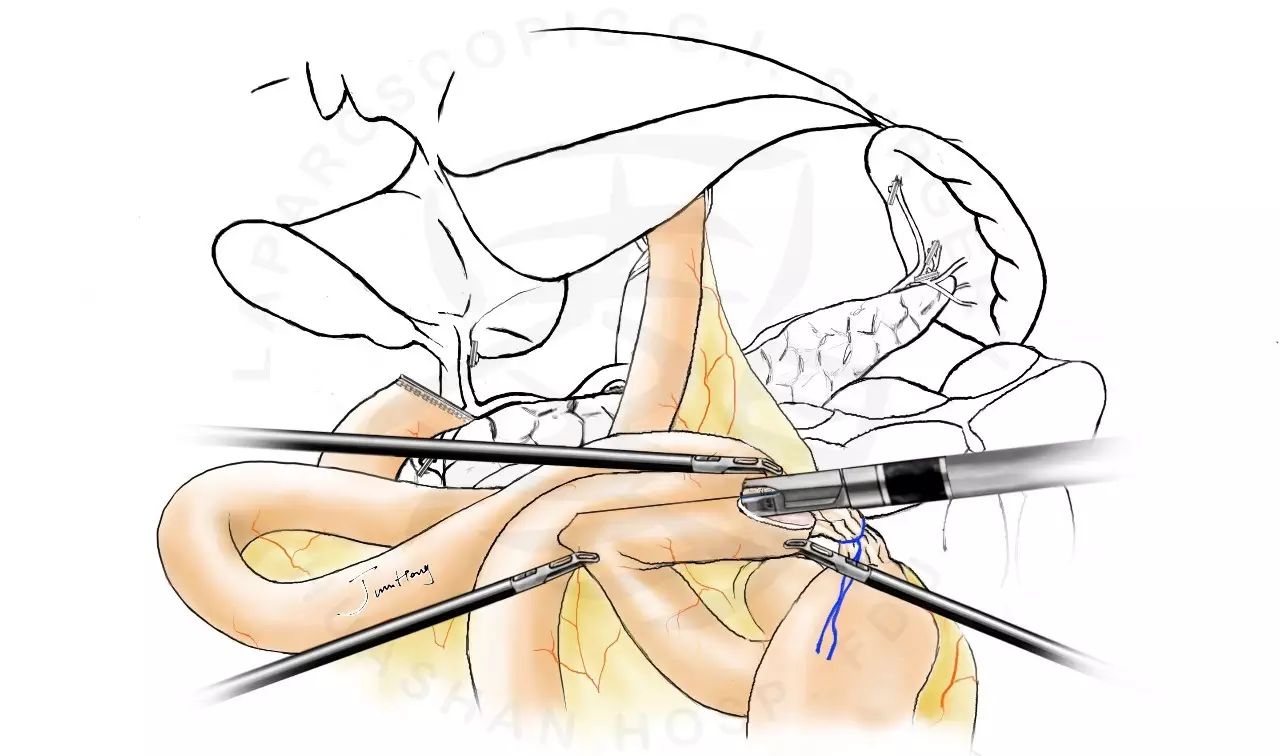 图解splt——全腹腔镜全胃切除后重建的新方式