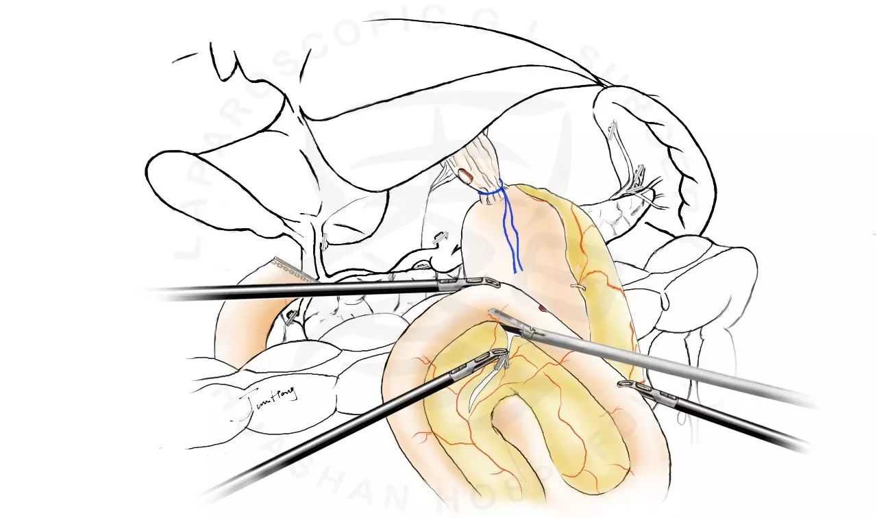 图解splt——全腹腔镜全胃切除后重建的新方式