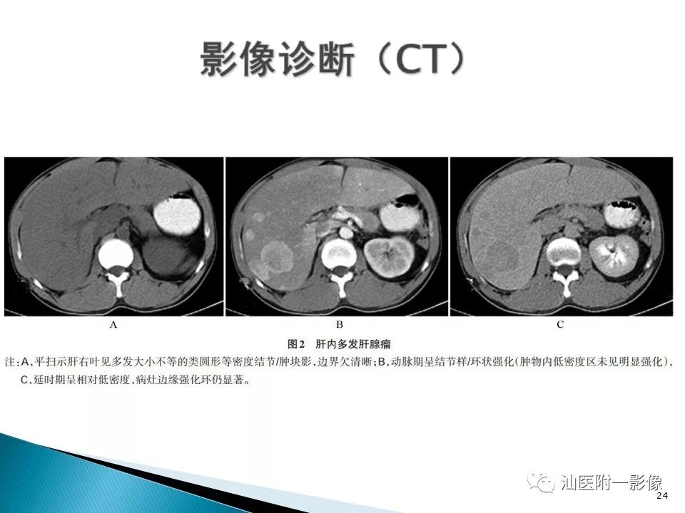 肝腺瘤影像诊断与鉴别