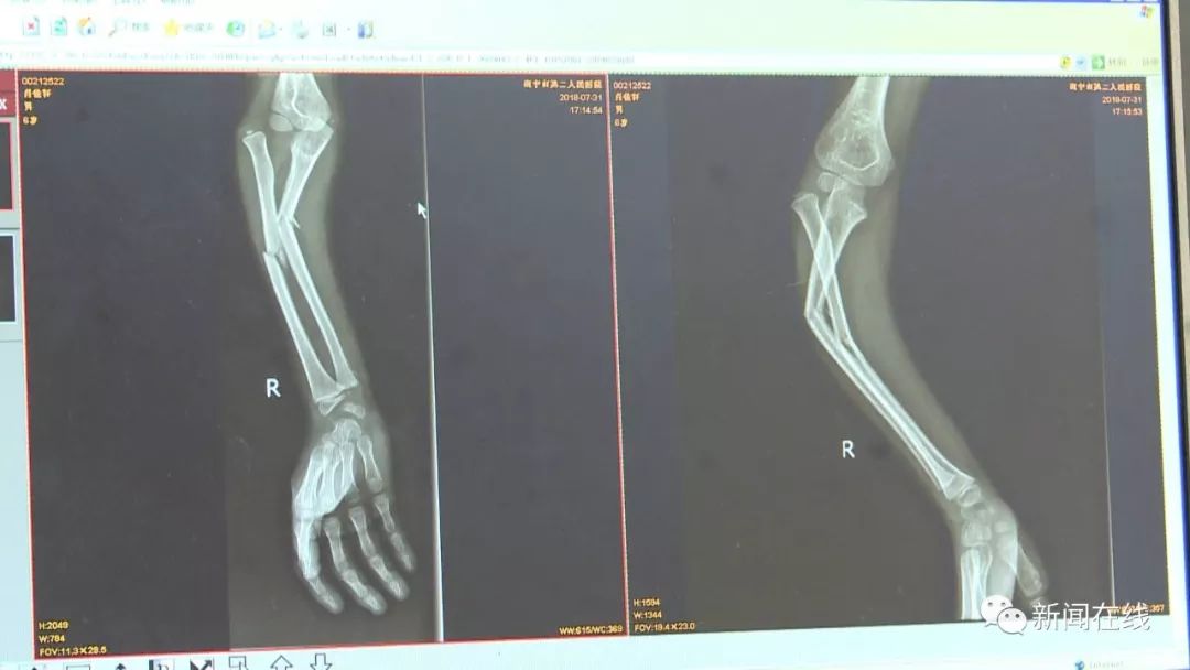 南宁一六岁男孩玩蹦蹦床时右手臂被踩 导致骨折脱臼