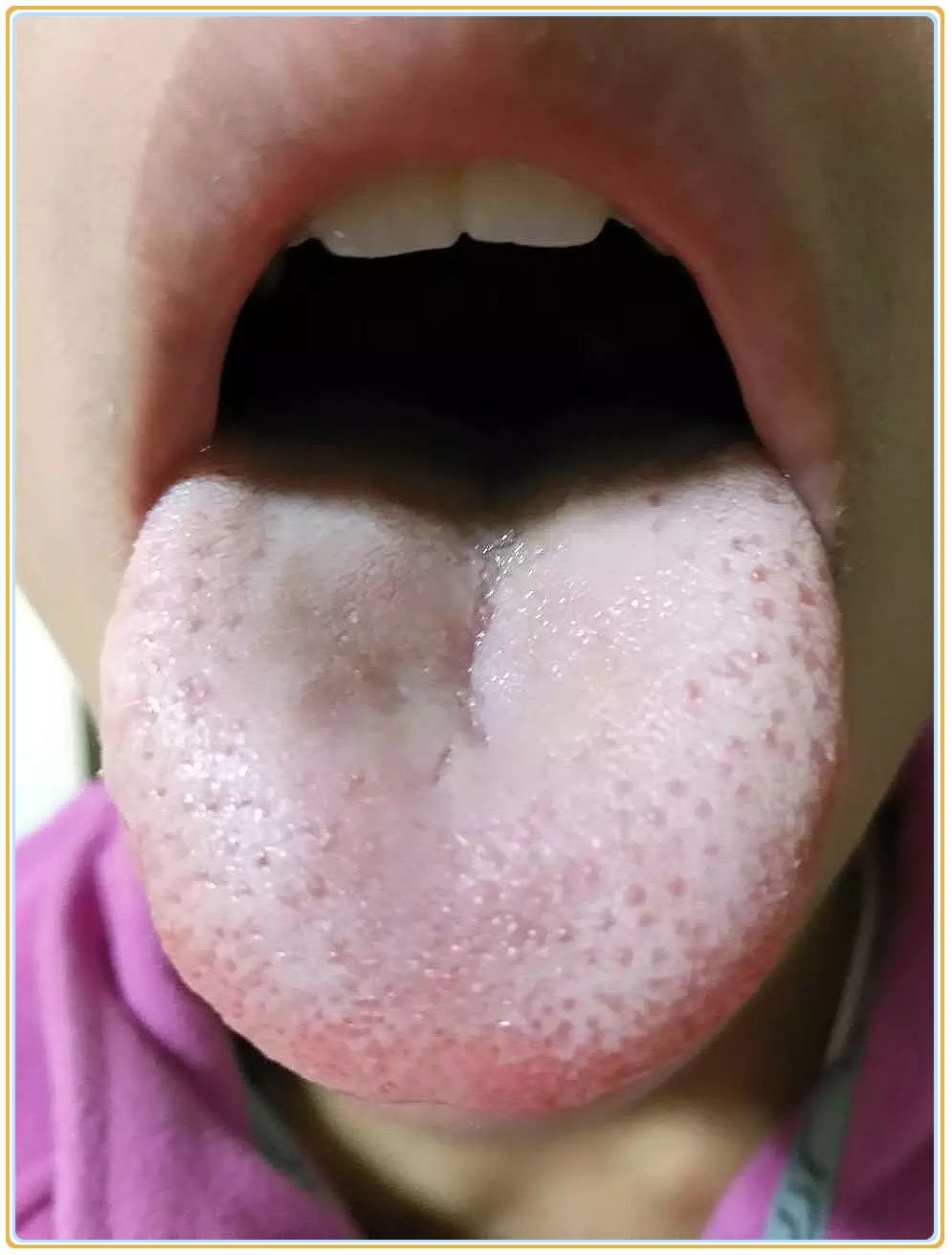 舌像解析|孩子舌苔满布舌体,中间厚,这是湿气与积食混杂的状态啊!