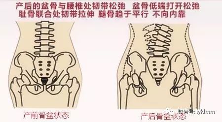 骨盆如果没有恢复好,会引起骨盆松弛,腰痛,耻骨痛,下腹部突出,o型腿