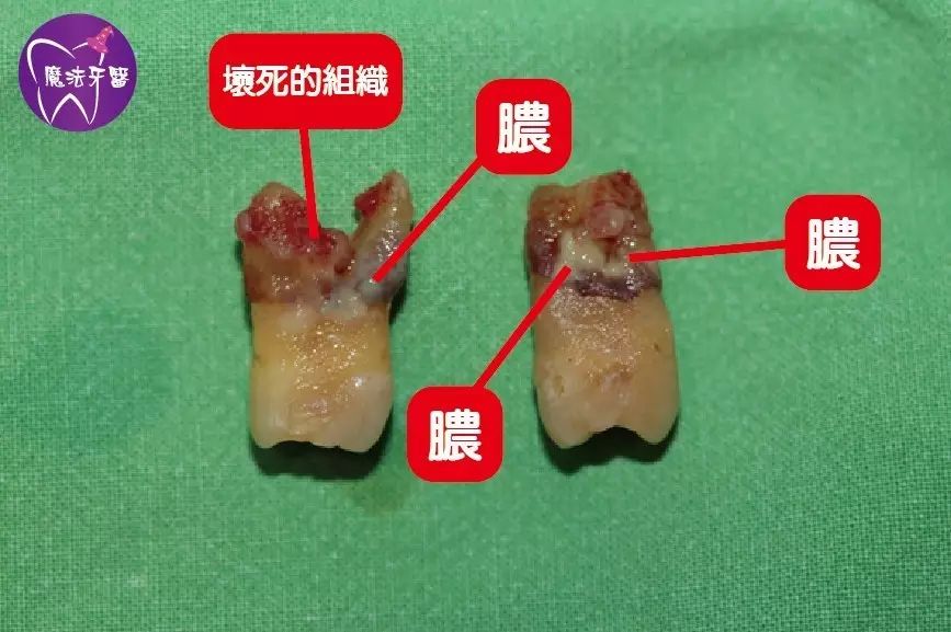 太可怕了!这些牙不拔,会让身体变成坟场!