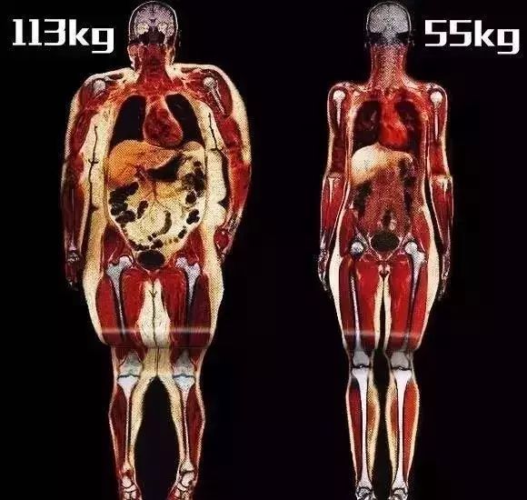 肥胖会导致内容脂肪堆积 下面是胖子和瘦子的对比.