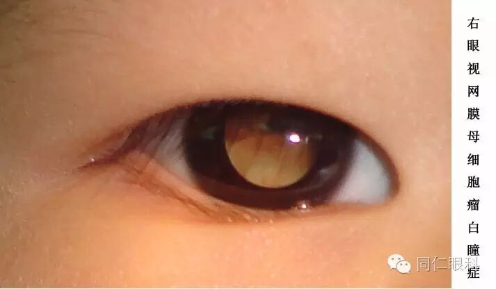 即视力丧失,瞳孔区黄白色反光,如同猫眼一样,闪闪发光