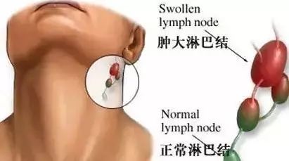 淋巴瘤:这种恶性肿瘤带走了罗京、阿桑