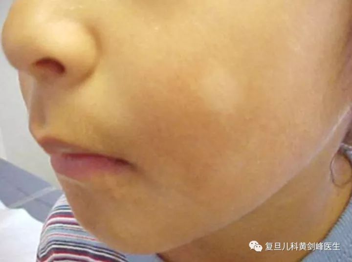 黄医生,我宝宝脸上的白点是虫斑吗? (转载)