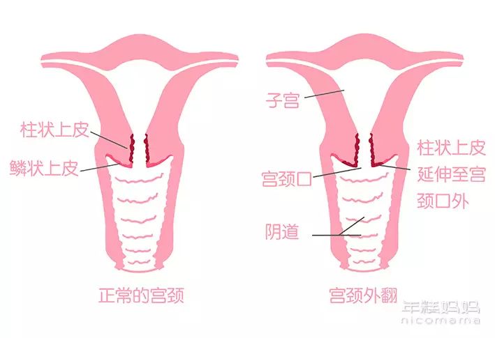 不是病! 宫颈糜烂,又被称为 宫颈外翻,是一种正常的细胞延伸现象.