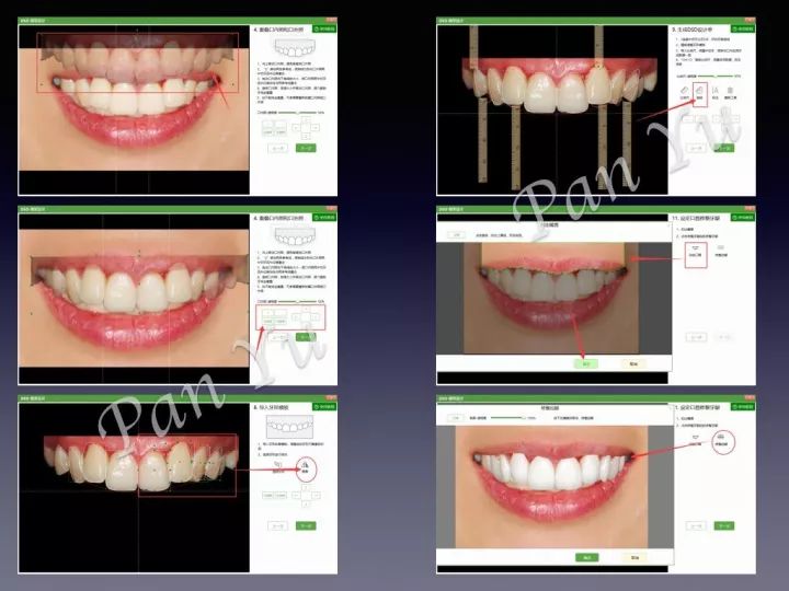 传统的方式是诊断蜡型,而现代化手段可以使用牙医管家dsd美学设计
