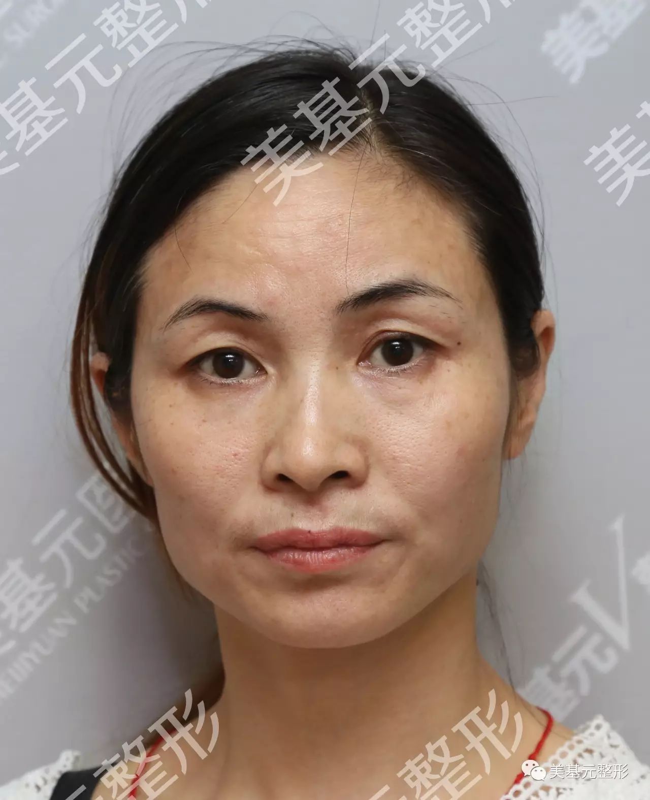 【真人案例】自体脂肪填充后,她成功逆龄20岁!