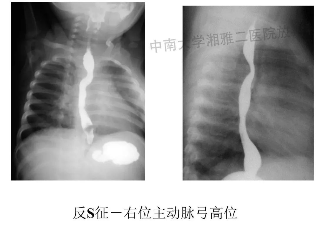 双主动脉弓