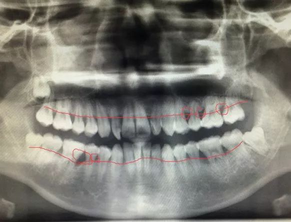 牙齿x-ray的辐射剂量非常小