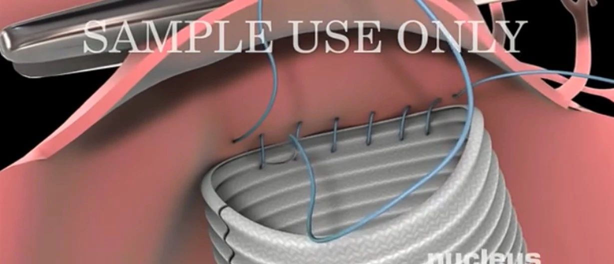 典藏3D:腹主动脉瘤的外科手术与介入手术