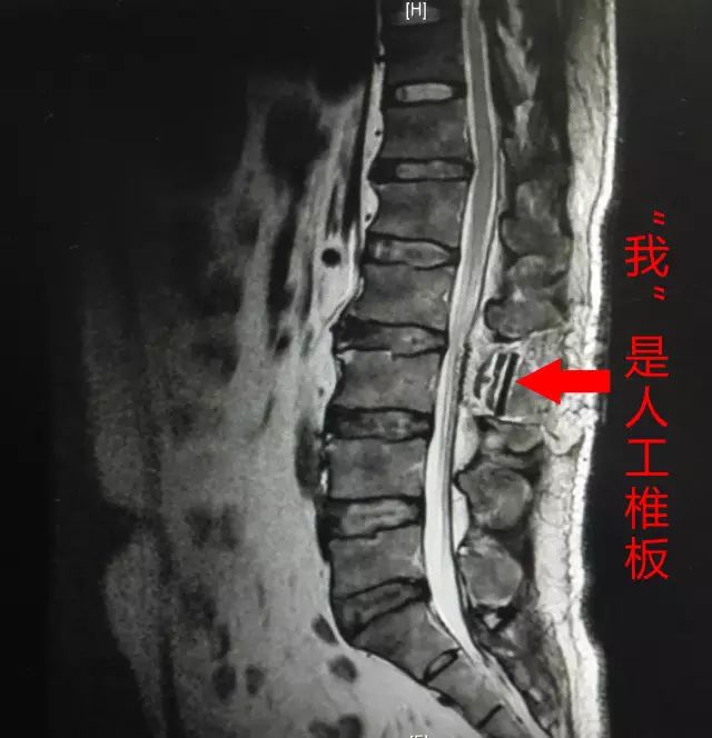 腰椎管肿瘤 神经鞘瘤(囊性变) 五,手术过程 全麻下行l2-3椎板部分