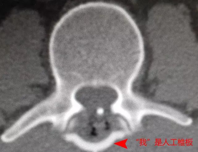 全麻下行l2-3椎板部分切除,剪开硬脊膜,发现黄色球形囊性肿瘤,并有