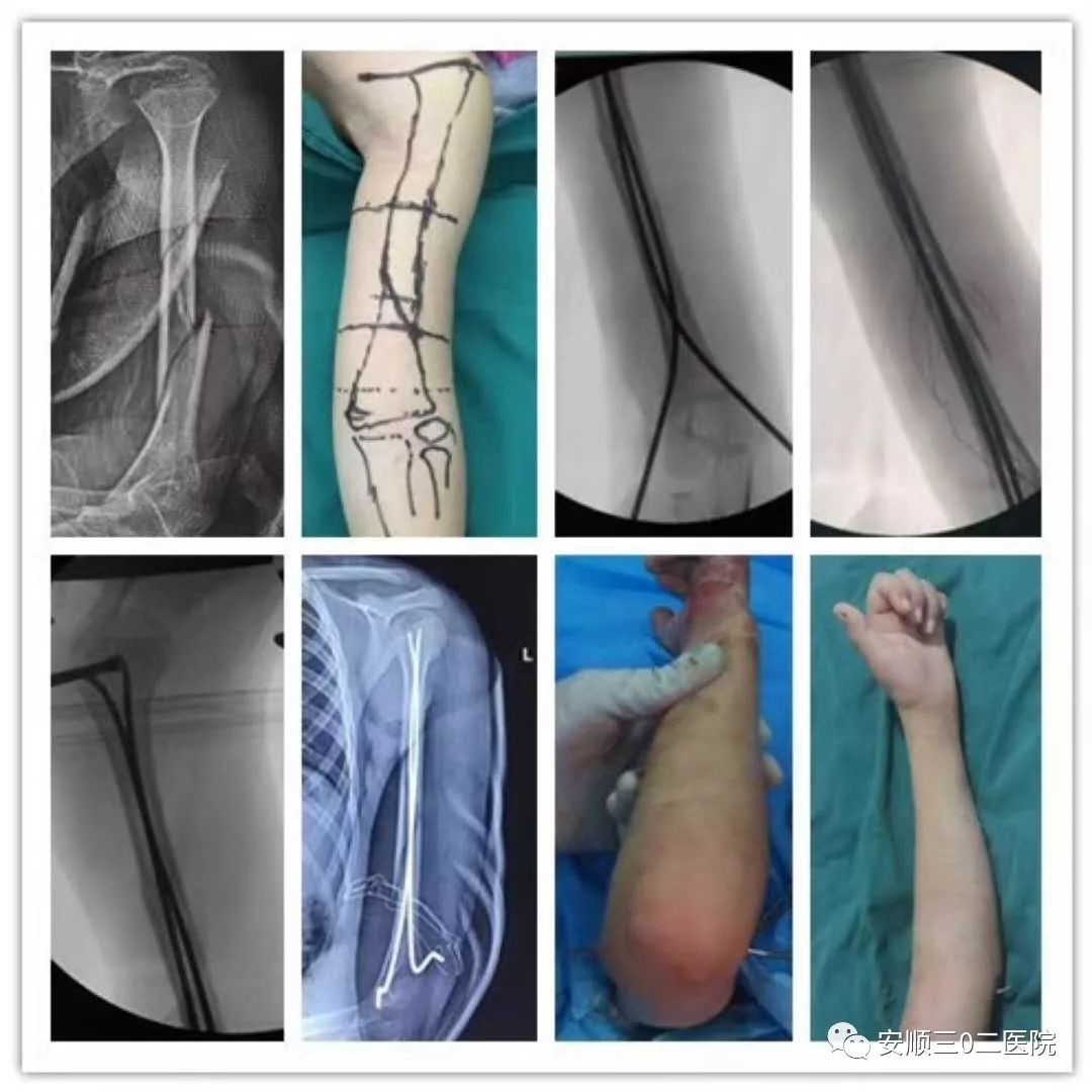 【医疗动态】三0二医院开展儿童肱骨粉碎性骨折闭合复位新手术