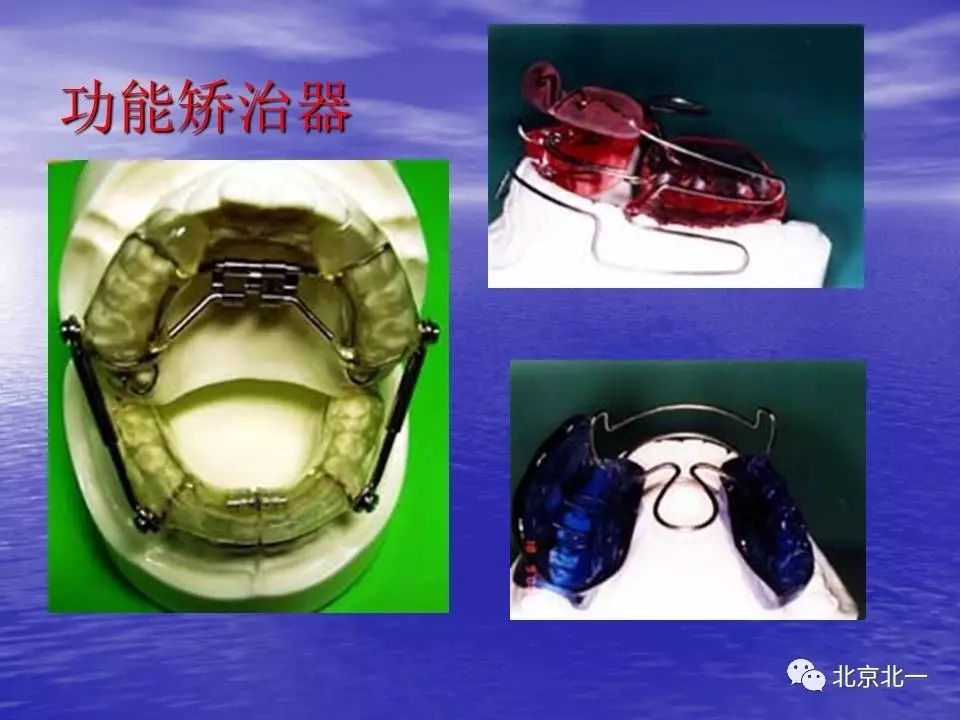 【正畸】活动矫治器