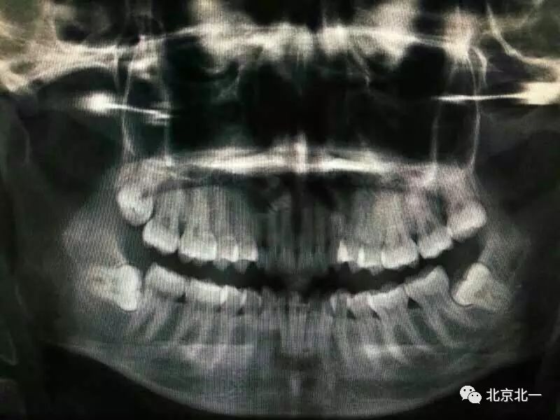 阻生牙(下颌第三磨牙)的分类