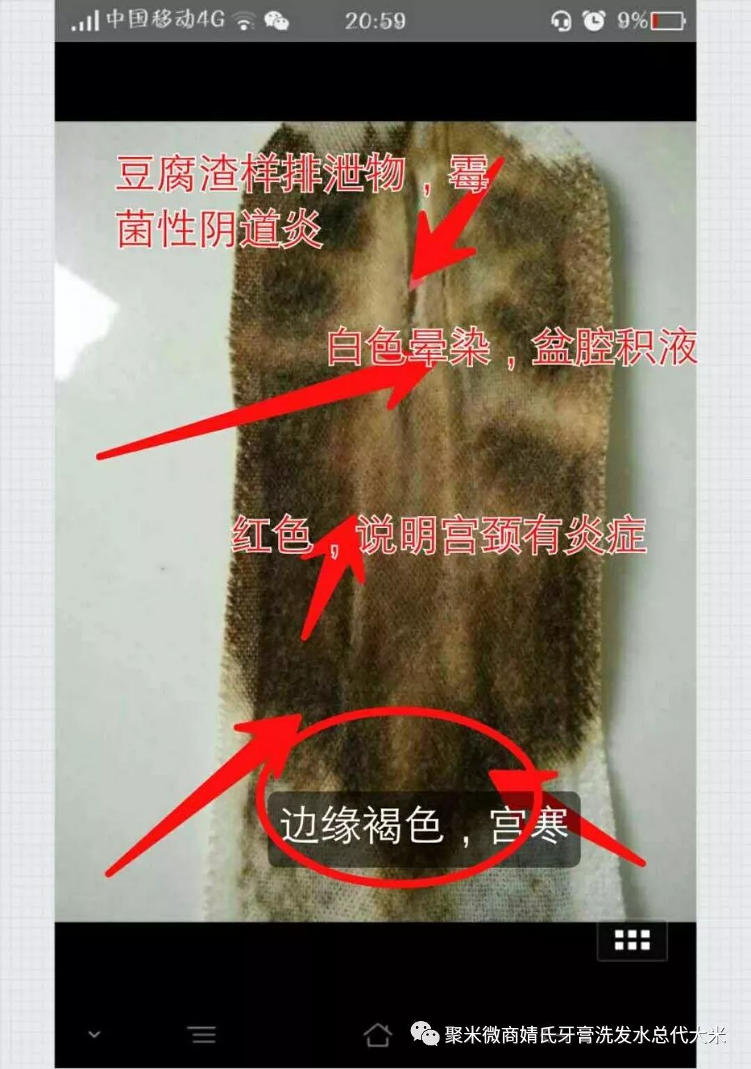 婧氏舒芯宝治疗宫颈糜烂需要多久?多少钱一个疗程?