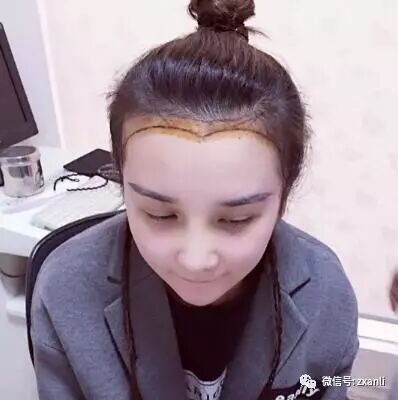发际线种植手术，现在已经手术后5个月了，头发种植效果很好