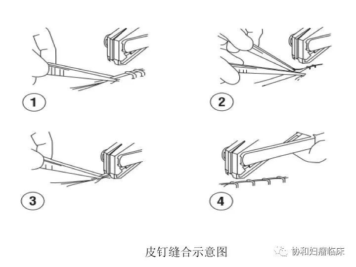 2)   妇科开腹手术丝线或皮钉的伤口,若为横切口,一般术后5天就可以拆