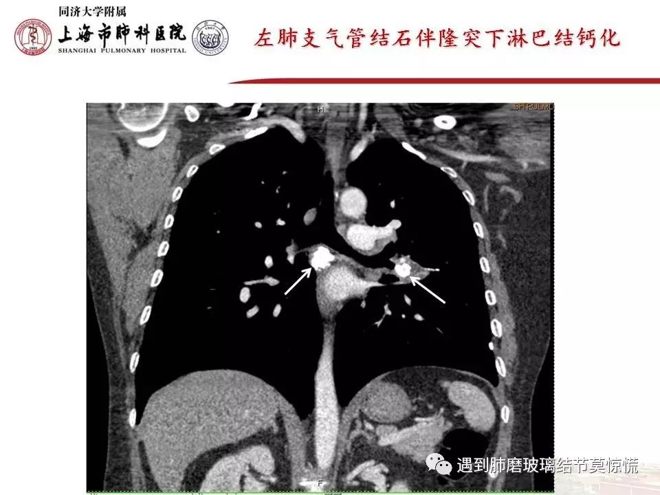 高密度钙化影伴有远端支气管阻塞征象,同时可伴有肺门纵隔淋巴结钙化