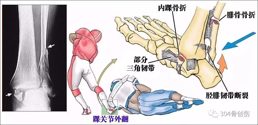 pott骨折机制