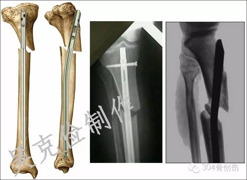 屈膝位胫骨骨折髓内钉固定
