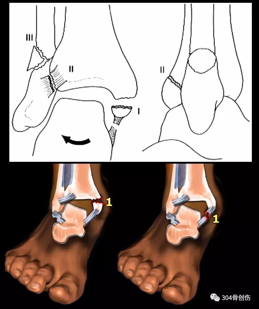 受伤时足处于旋前位,距骨受到强力外展或外翻应力,踝关节内侧结构受到