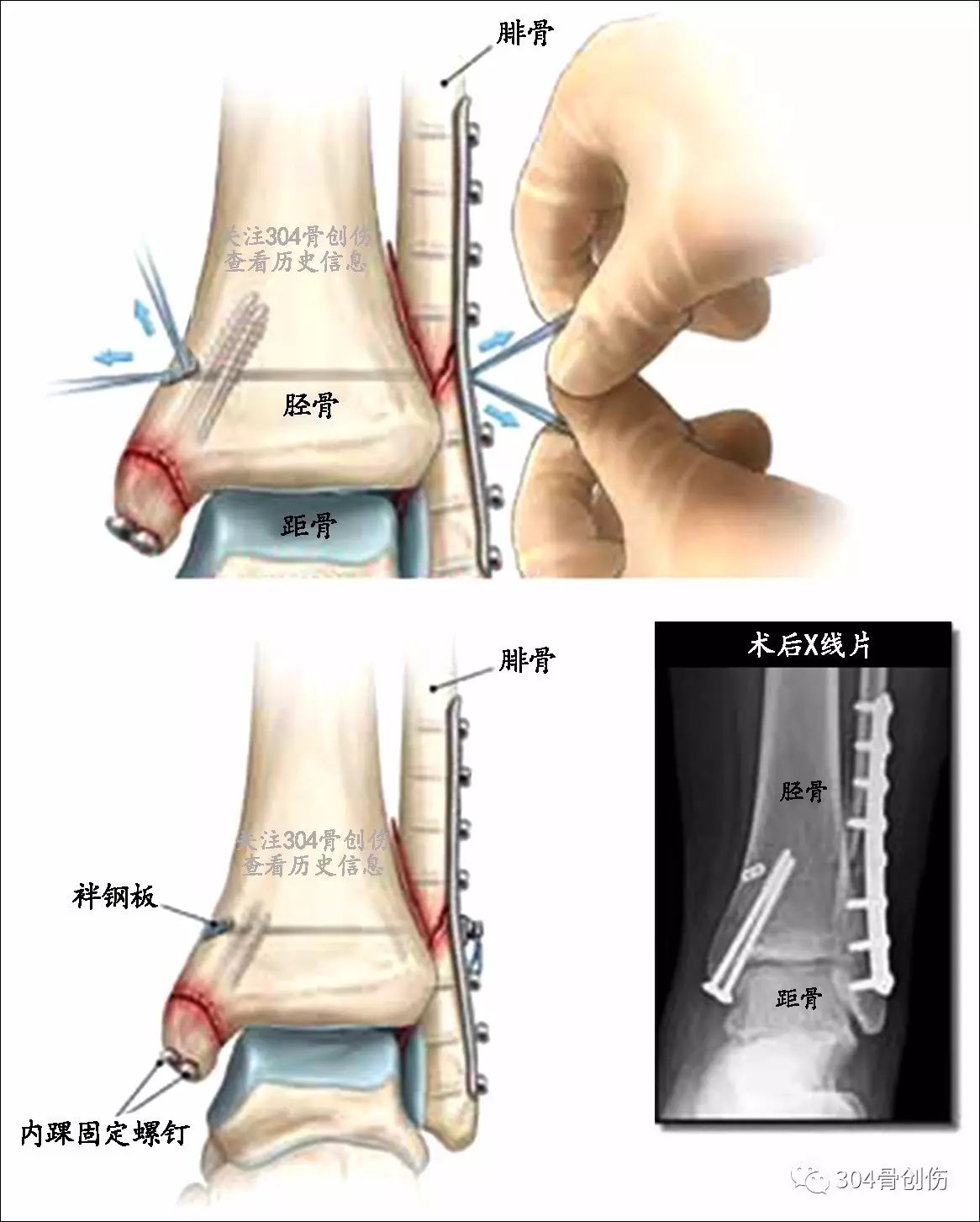 踝关节骨折(十)下胫腓联合3