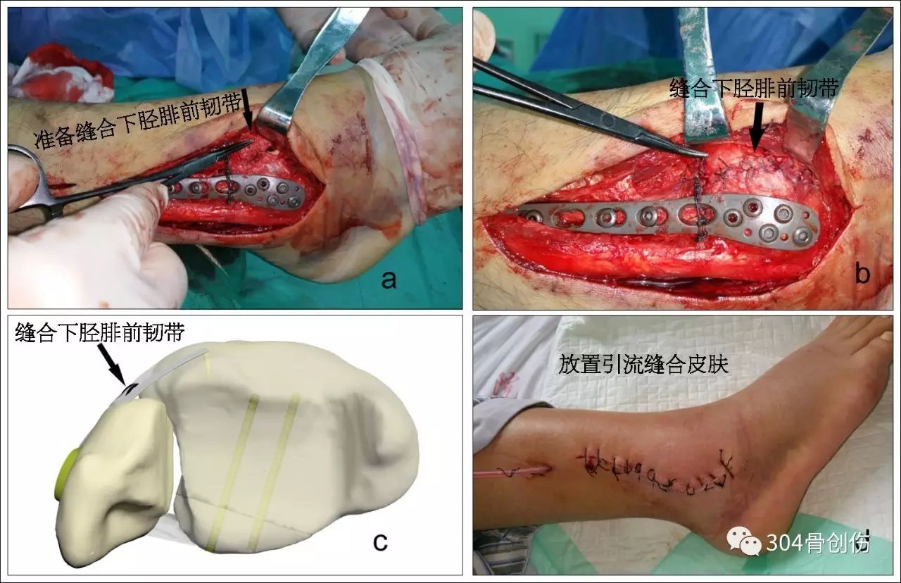 踝关节骨折(十一)下胫腓联合4【山东建筑材料网络社区